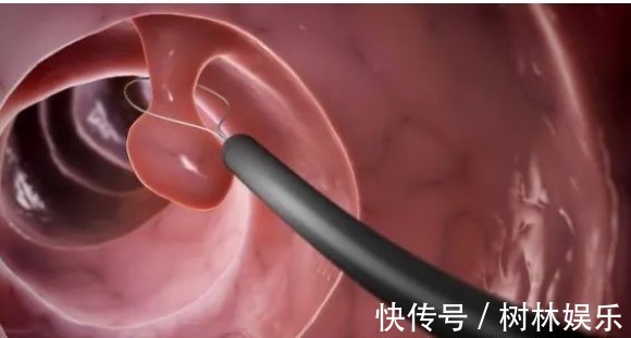 科室|结节、息肉、囊肿、增生哪个最可能癌变这么多年疑惑终于解开了