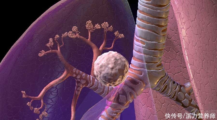 加工|肺癌患者正在逐年增多?医生实话实说:除了吸烟还有4大主要原因