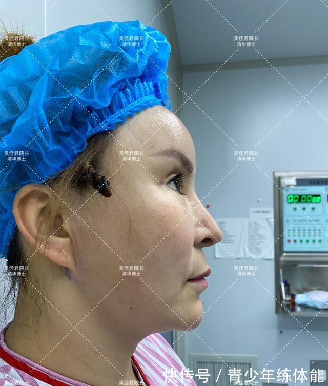 拉皮 小拉皮术后6个月,让她从老阿姨逆袭小姐姐!