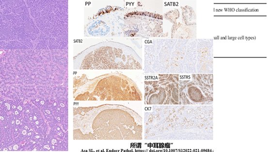 副神经节瘤|「其他部位神经内分泌肿瘤」学习笔记