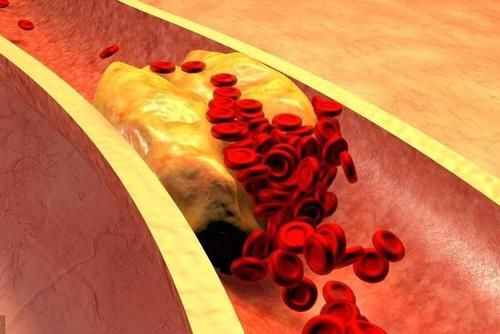 堵塞|颈动脉如果被堵塞了,哪个部位反应最强烈?看完或许有帮助