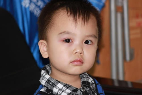 双眼皮能揉出来?3岁男童视网膜脱落,只因妈妈的“双眼皮执念”