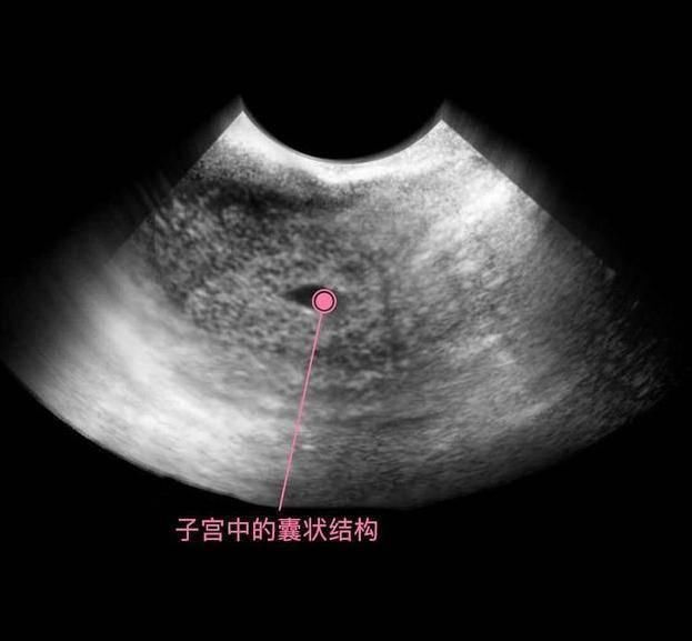 性别|胎儿从卵泡到性别形成,17张图片清晰诠释,男宝女宝看得很清楚