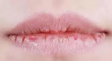 血液黏稠也分有3种程度,医生:别到最后1种才后悔没有重视