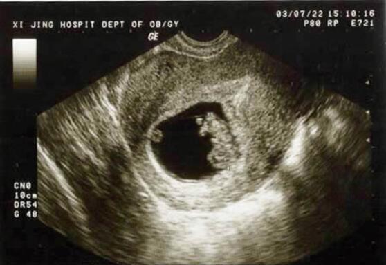 小果|怀孕7个月却没有在子宫内发现胎儿,孩子哪儿去了