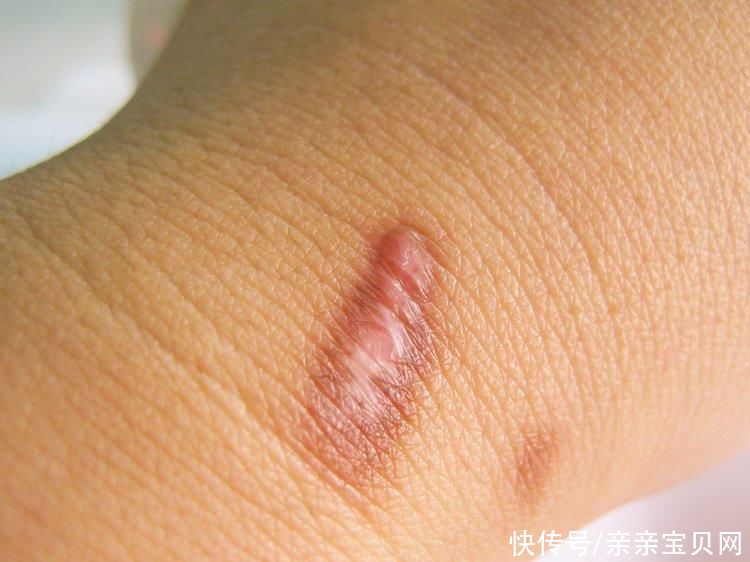 二度烫伤会留疤吗