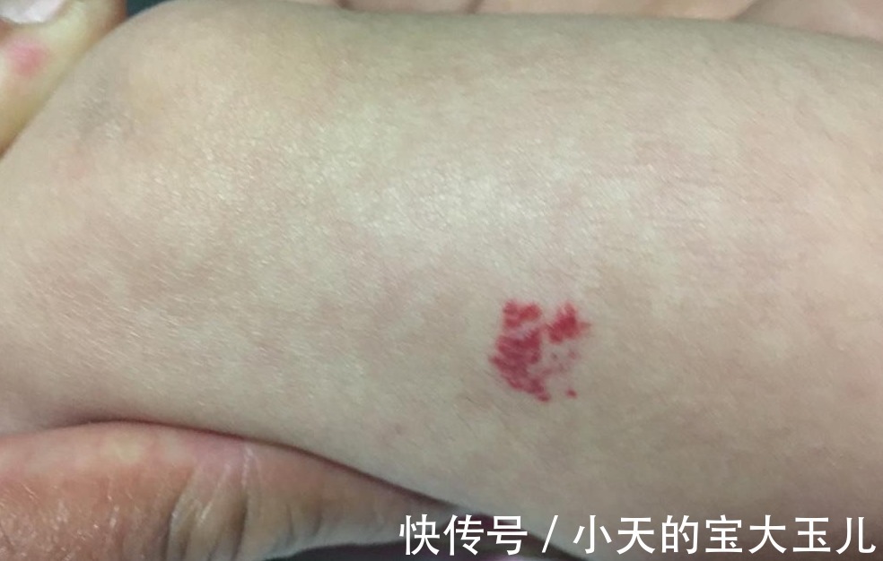 化妆品|婴儿身上为什么会有胎记?资深医生说出原因,与“孕期行为”有关