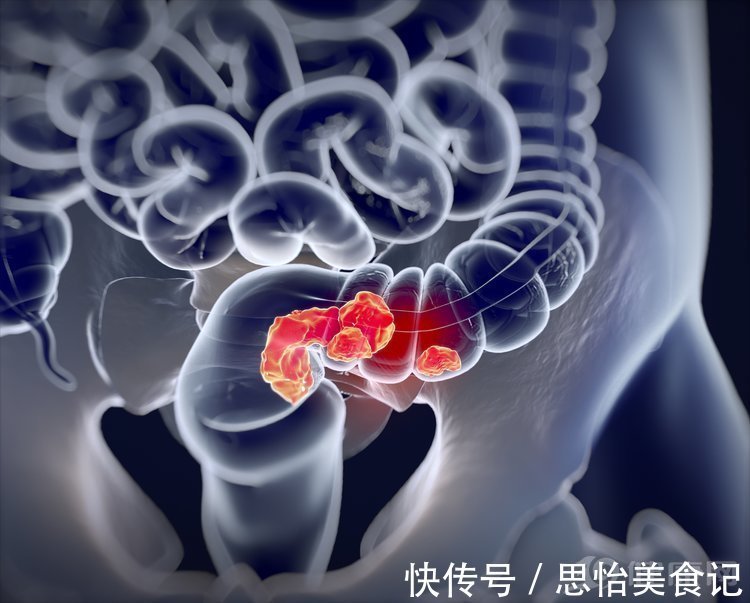 饮食习惯|棋圣聂卫平患癌后的反思：为什么我不生气，还是得了癌症？