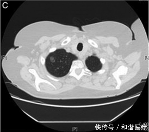 肺结节是肺癌前兆吗?要不要切?