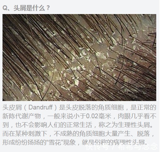 头皮|还在怀孕如何去屑的路上挣扎吗?一篇全方位“终结”你的孕期头屑