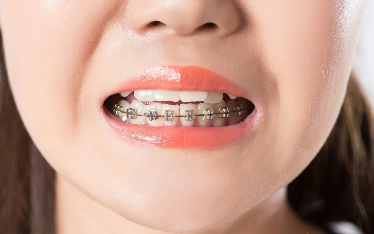 牙齿矫正|儿童做牙齿矫正三个最佳时间:家长要牢记,矫治越早干预效果越好