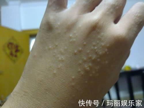 水泡|夏天出汗后，手脚出现水泡是怎么回事不重视可能危害健康