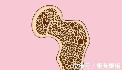 癌症|癌症出现骨转移,说明已经进入晚期,无法治愈了吗?医生解答了