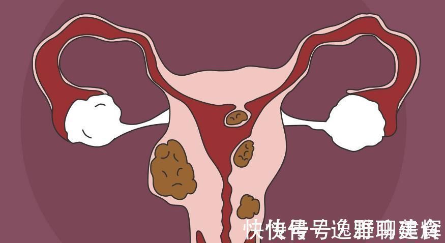 葛根粉|你有“子宫肌瘤”吗?饭前来点“此物”,消除肌瘤,补气益脾胃!