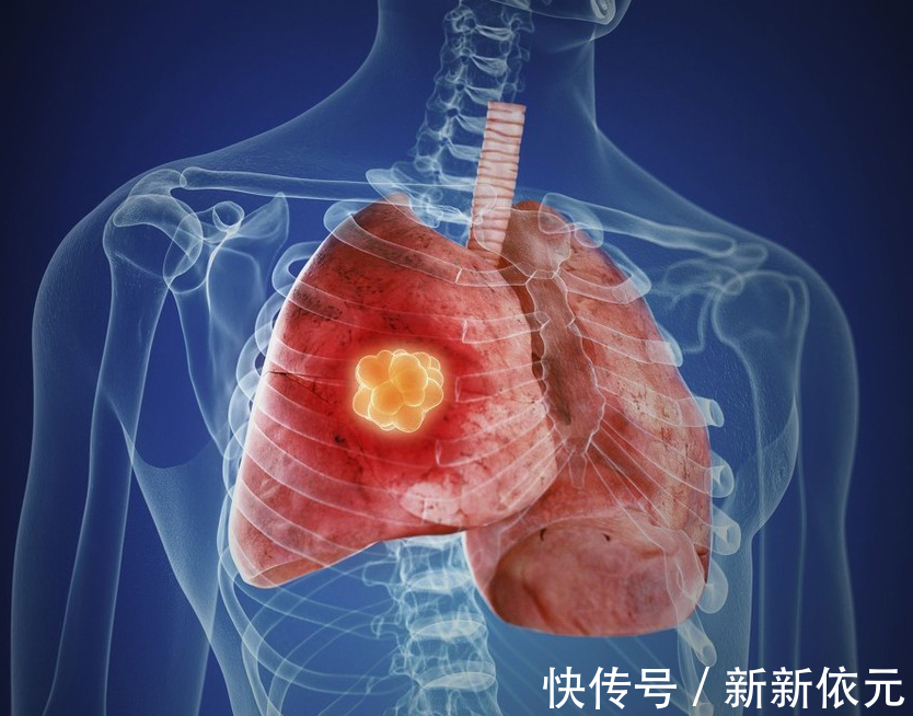 感染性疾病|诊断肺癌后有人不知不觉活过3年,有人炸油条做生意活过5年