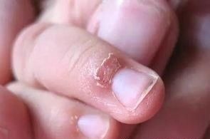 孩子|喜欢“啃指甲”的孩子,长大后会变成啥样医生逃不过两个结局