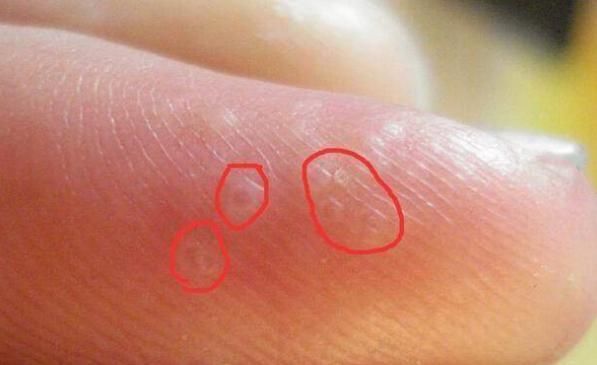 疱疹|手上出现此类“水泡”,切莫忽视,多半是“它”要来了!