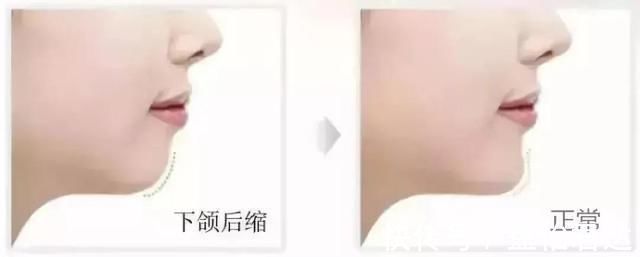 牙齿|孩子12岁前必须处理的牙齿问题!家长都了解吗?