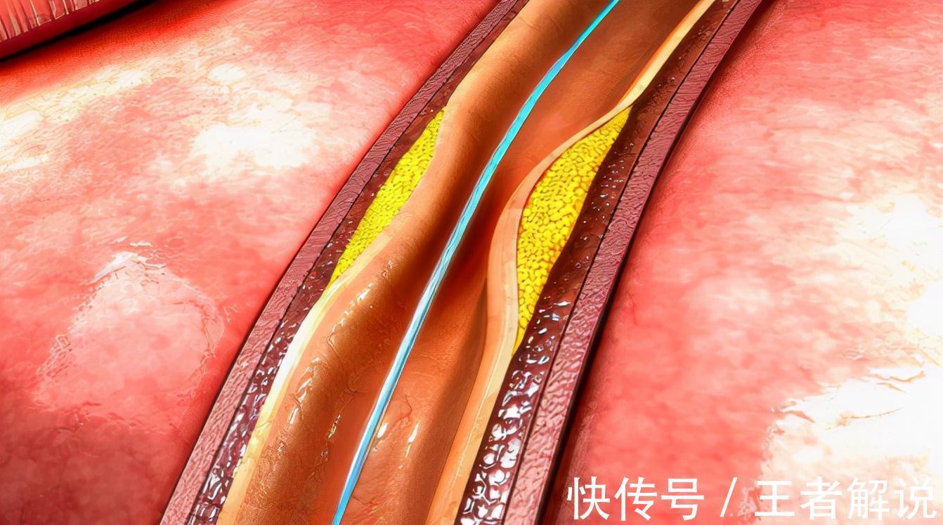 心梗|冬季气温降低,小心中风,心梗的发作,5个方法教你保护心脑血管