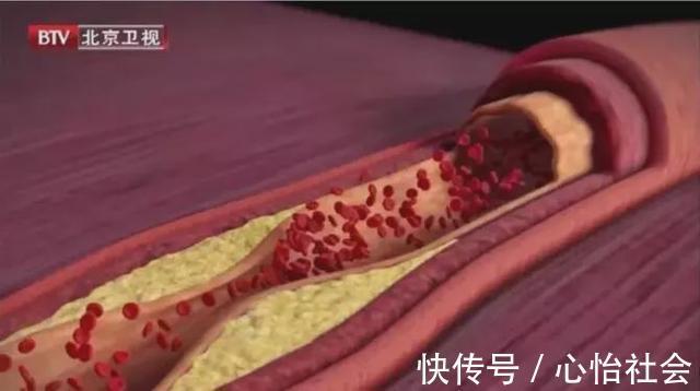 血管|血栓最怕这种豆!没事吃几颗,血管通畅,血栓偷偷“溜”走