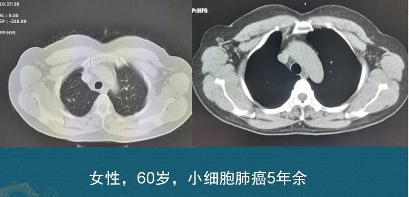  查出癌症不放疗不化疗，保持良好心态吃喝玩乐，能扛过去吗？