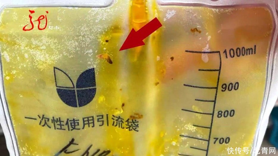 寄生虫|肚子里一天流出十多只虫子,就因为他吃了这种鱼……