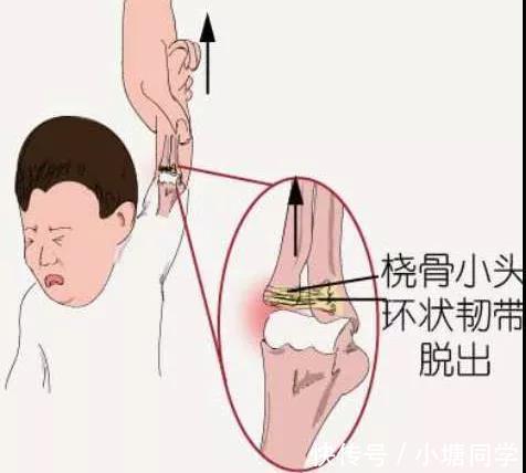 脱臼复位