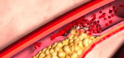 张女士|42岁女子突发脑梗昏迷，跟她几小时前做了这个部位的按摩有关