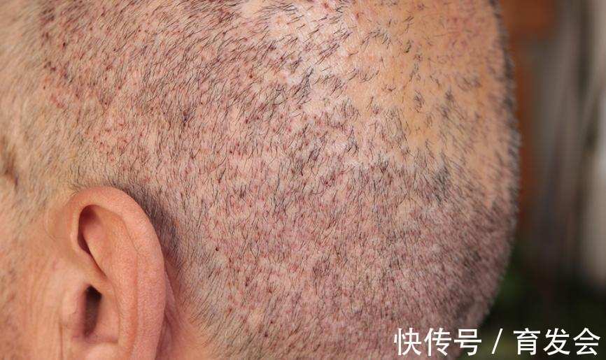 成活率 用植发生发,你要闯过这些难关,否则白费!