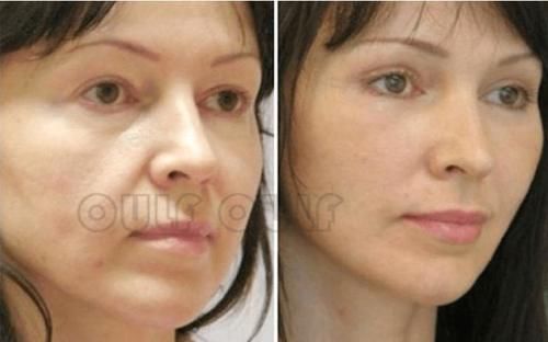 全脸埋线多久恢复自然、线雕恢复期是多久