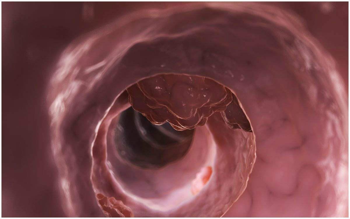 结直肠癌|一天三次大便和三天一次大便，究竟哪个是大肠癌，现在检查还不晚