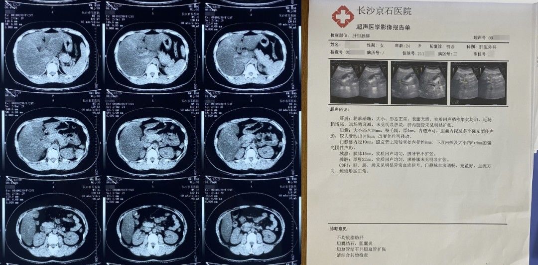 奶茶|留学生爱吃炸鸡配奶茶，频发腹痛查出竟患有胆结石