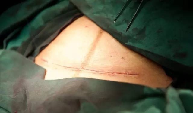 妈妈|剖腹产后没多久,肚子竟还是大如球,医生再次手术时也惊出一身汗