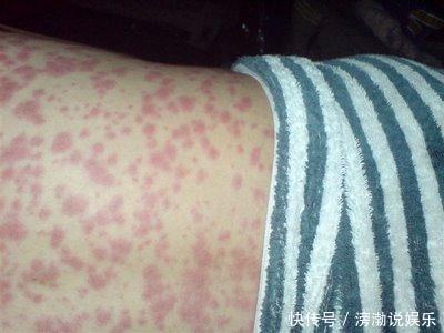 全身痒是艾滋病前兆吗