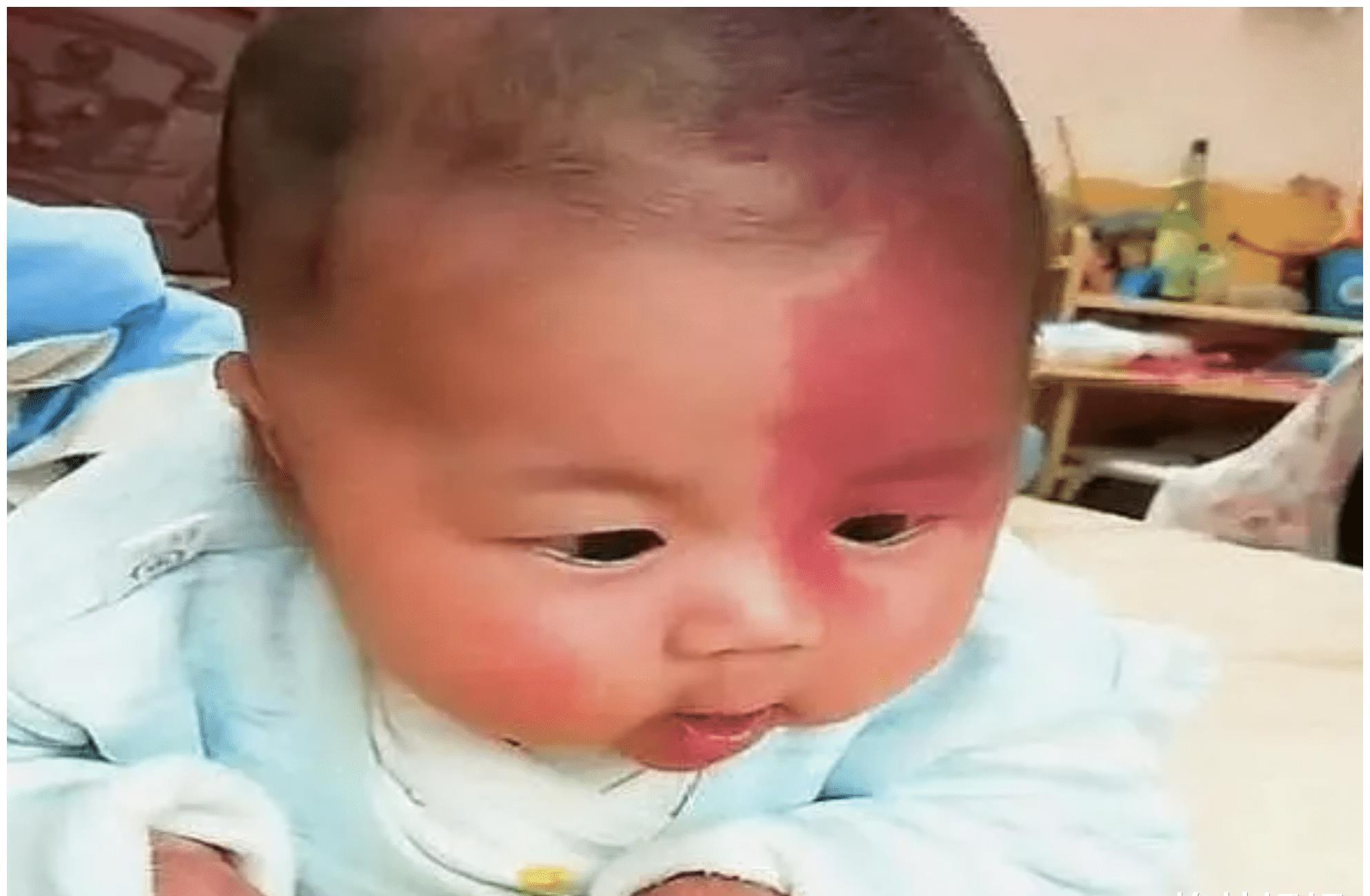 孕妇|胎记是怎么来的?产科医生:孕期这2种行为易长胎记,孕妈要避开