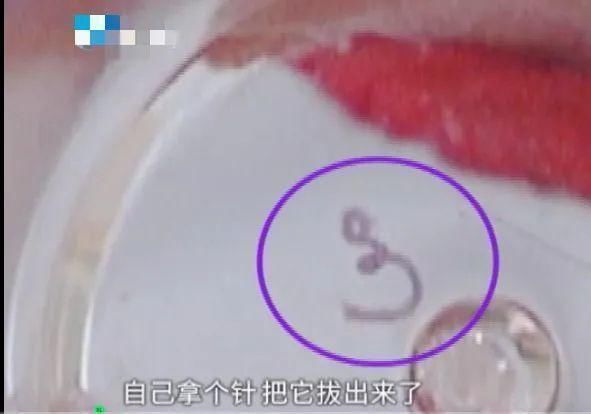 洛阳华美|可怕！女子术后脸上长包，大夫说上火，吃药一个月后，竟从脸上揪出……