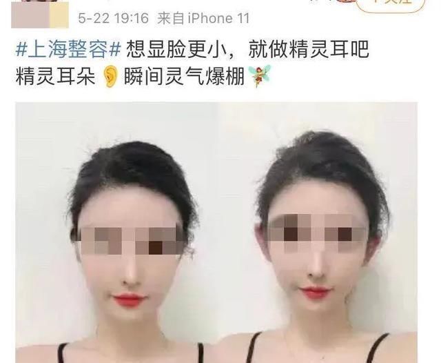 整容|医生，我耳朵不够精灵