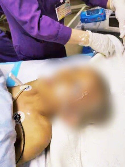 农药|女儿被妈妈用农药焗头驱虱进ICU