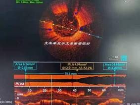 冠脉介入治疗|市中心医院完成营口地区首例在OCT指导下冠脉介入治疗