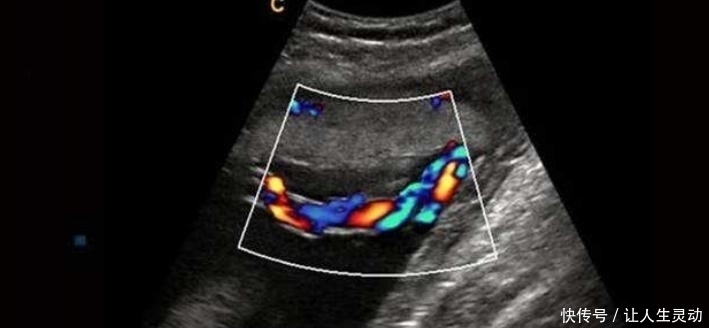 信号|胎儿没出生就脐带断裂,医生也无能为力,孕妈抓住宝宝求救信号